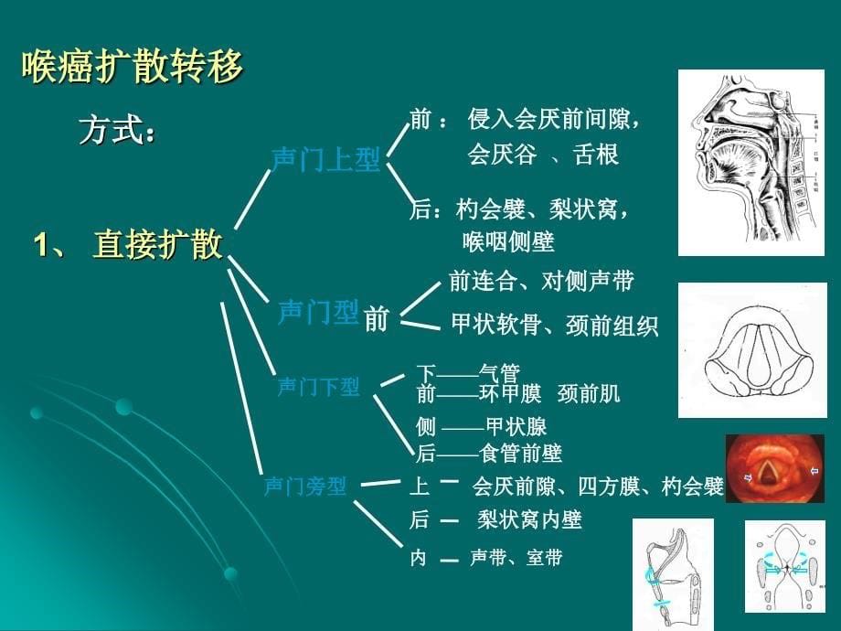 喉癌的护理.ppt_第5页