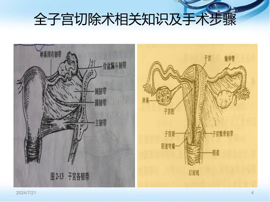 经腹全子宫切除术相关知识及手术步骤ppt参考课件_第4页