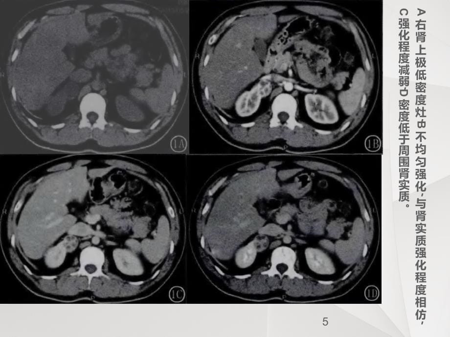 肾癌CT表现共22页_第5页