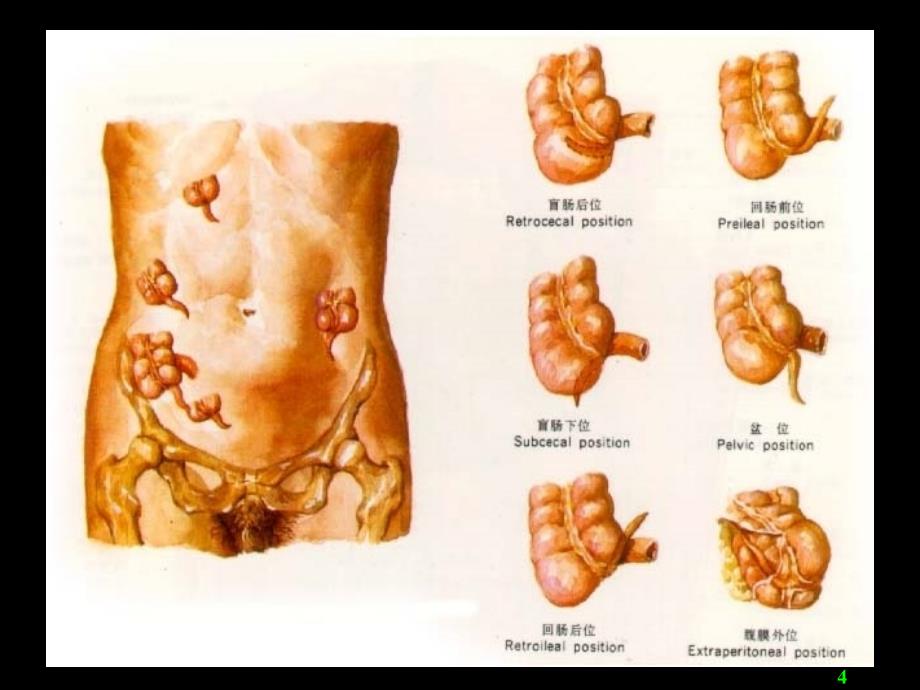 阑尾炎Acute_appendicitis_第4页