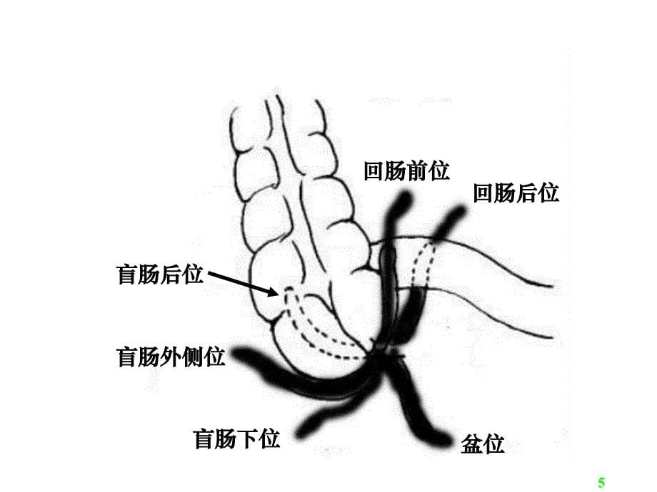 阑尾炎Acute_appendicitis_第5页