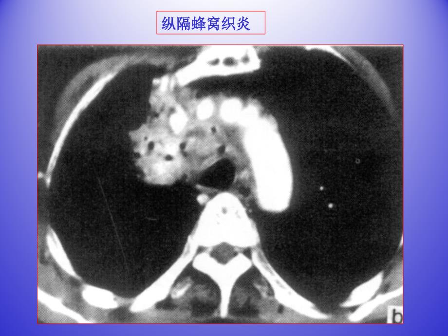 纵膈常见疾病的ct表现_第3页