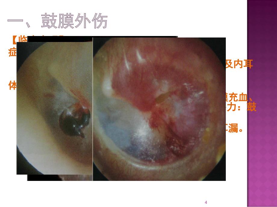 五官科学第六章耳鼻咽喉科常见疾病5耳部疾病ppt课件_第4页