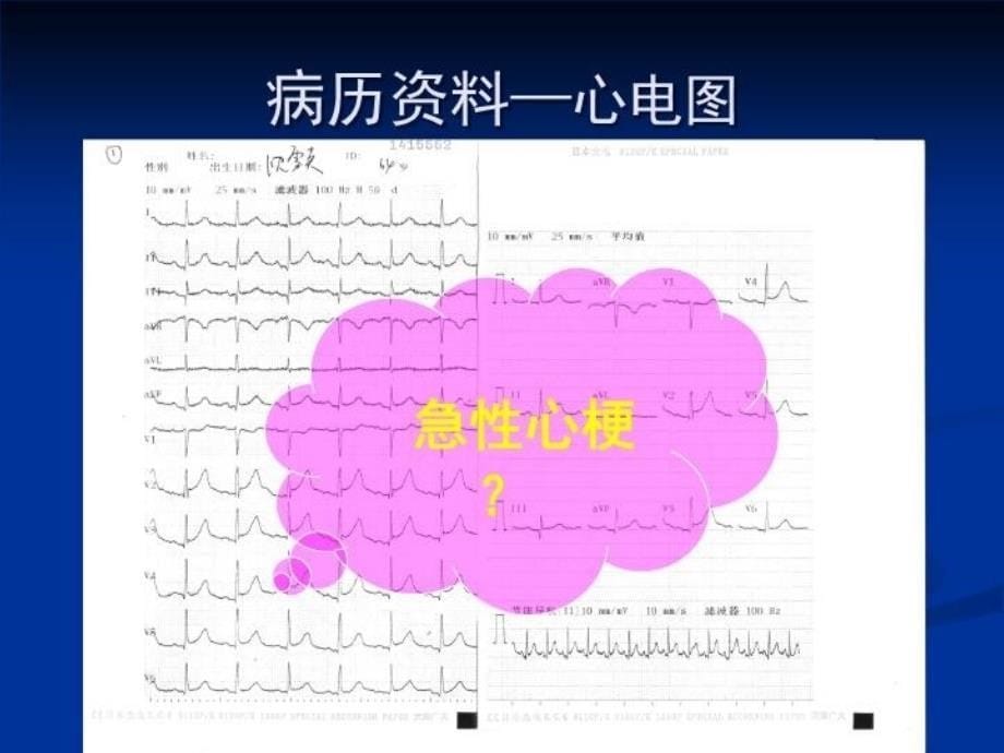 最新心尖球形综合征PPT课件_第5页