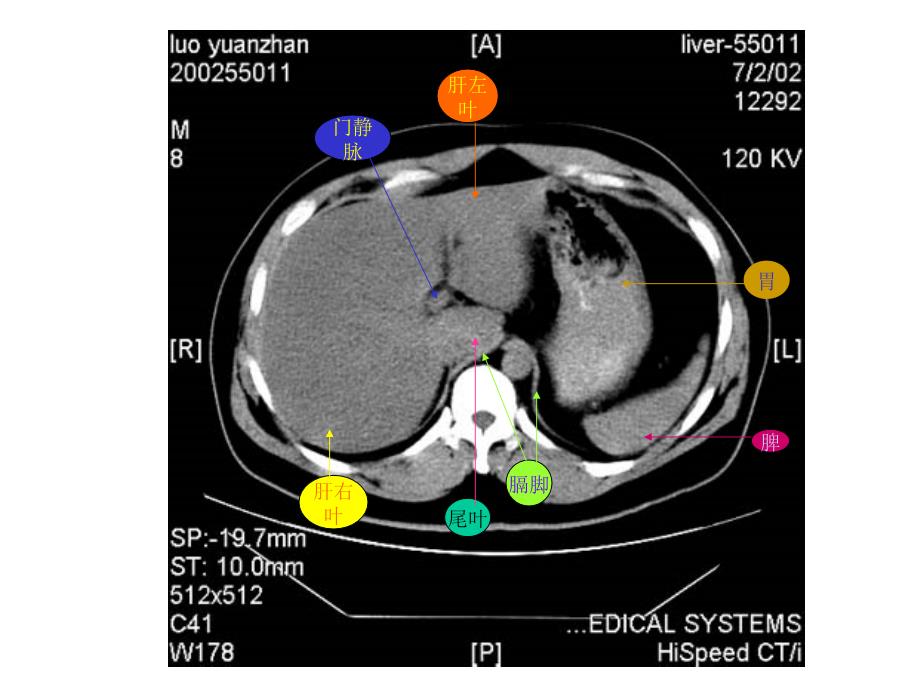 《教你认识腹部CT》PPT课件_第4页