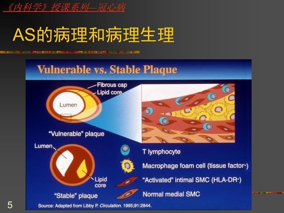 《冠心病》PPT课件_第5页