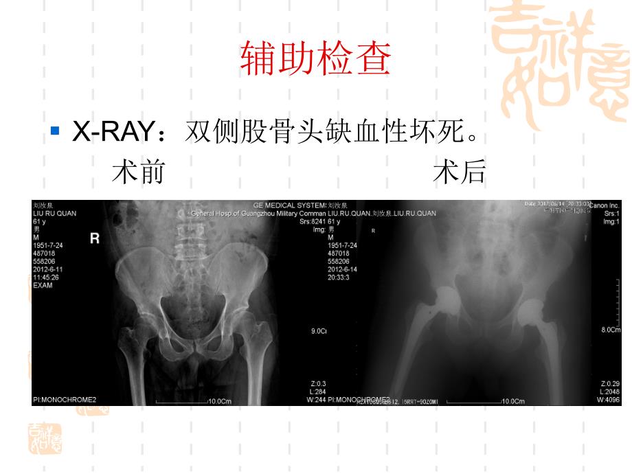 髋关节术后预防假体脱位的护理.ppt_第4页