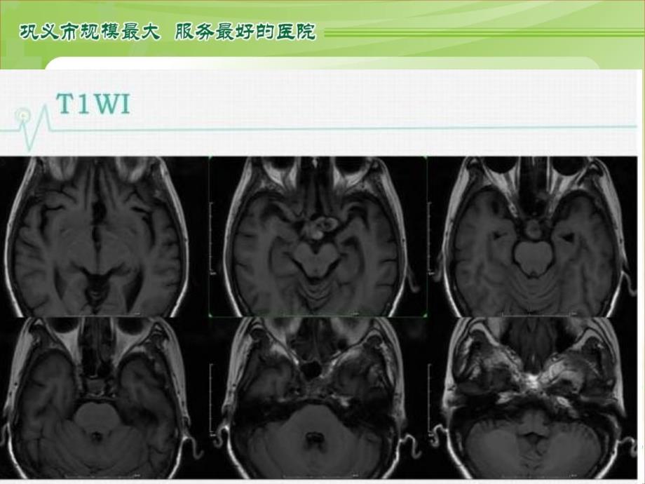 左侧颈内动脉动脉瘤_第3页