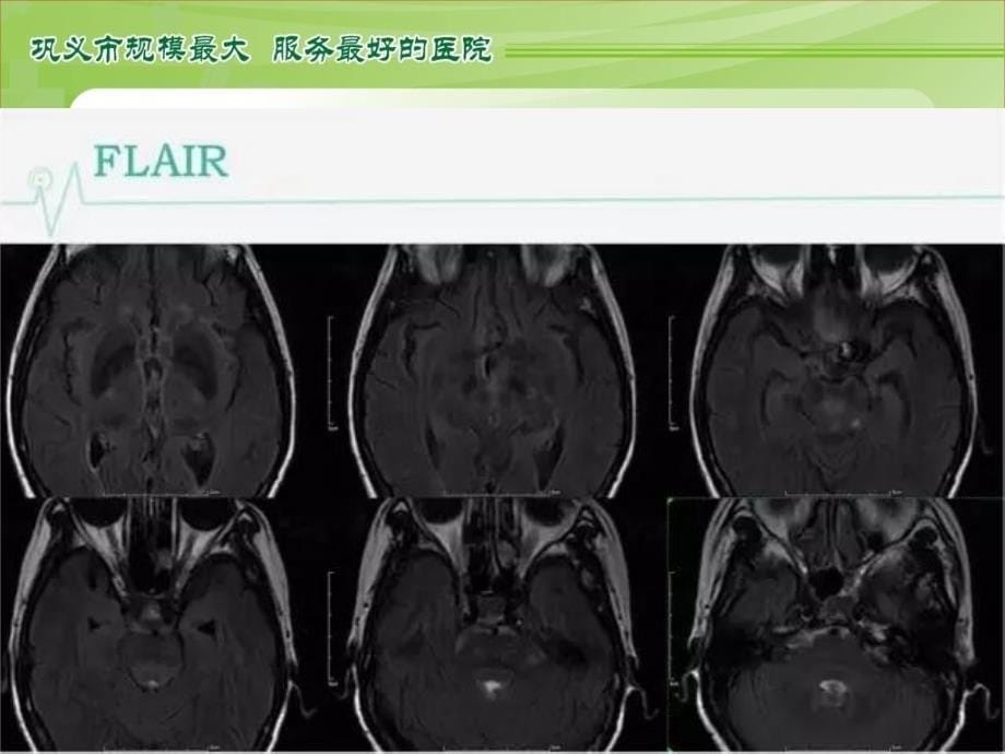 左侧颈内动脉动脉瘤_第5页