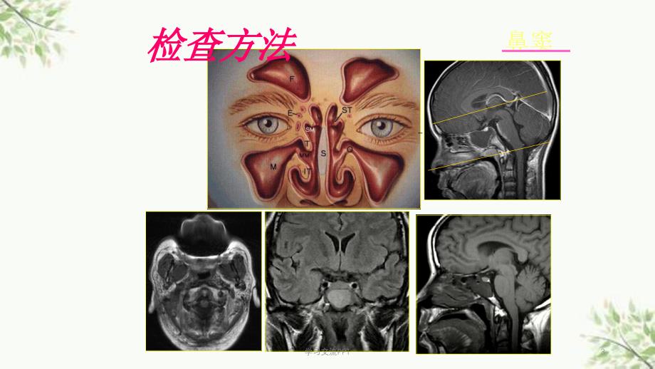 鼻及鼻窦影像诊断课件_第3页