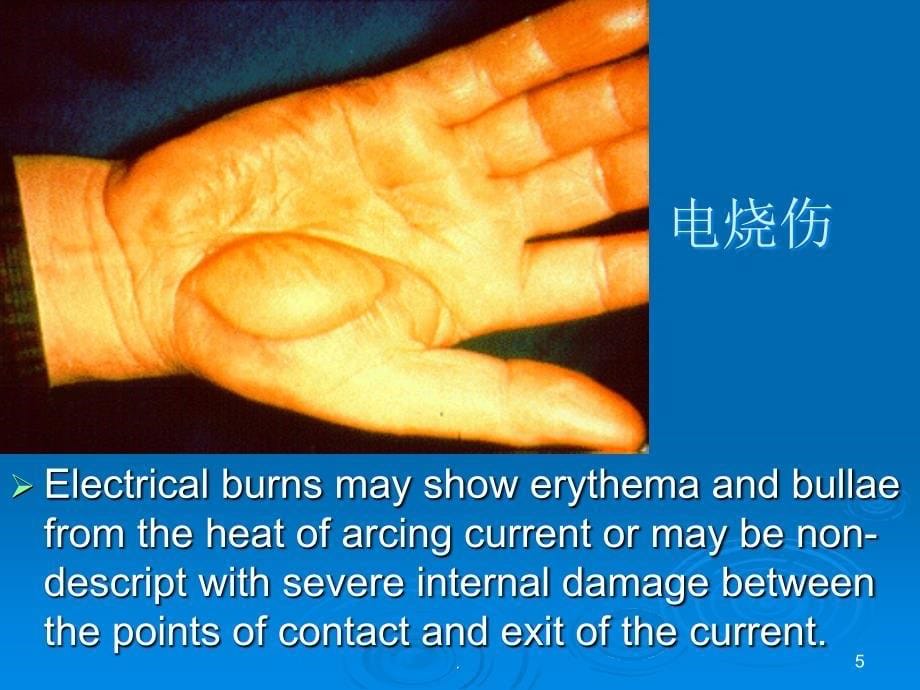 电烧伤和化学烧伤ppt医学课件_第5页