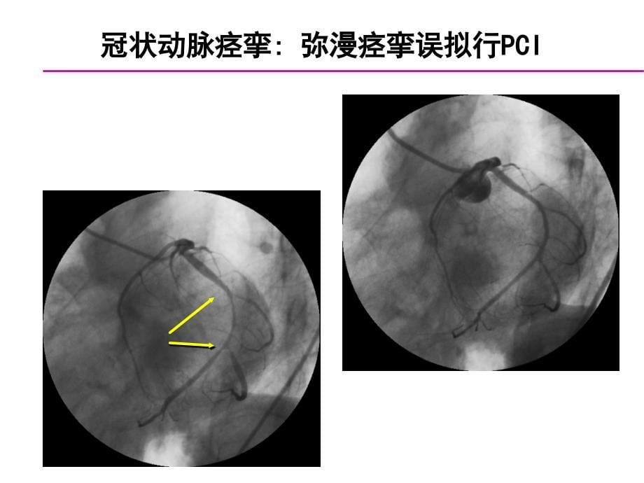 冠脉介入新技术ppt课件_第5页