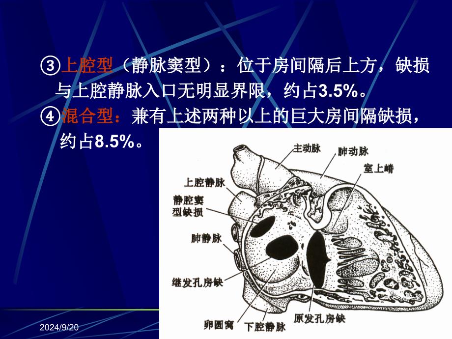 先天性心脏病PPT课件_第3页