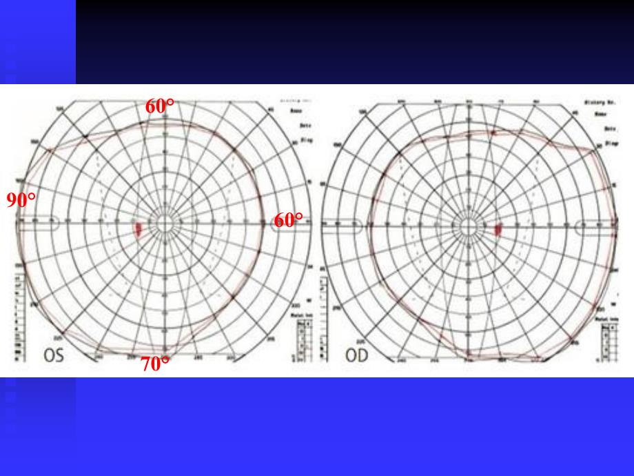 视野检查结果分析基础知识p都pt课件_第4页