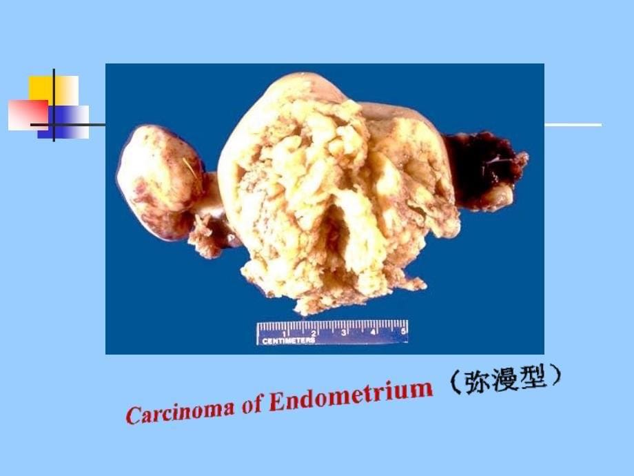 《妇产科子宫内膜癌》PPT课件.ppt_第5页