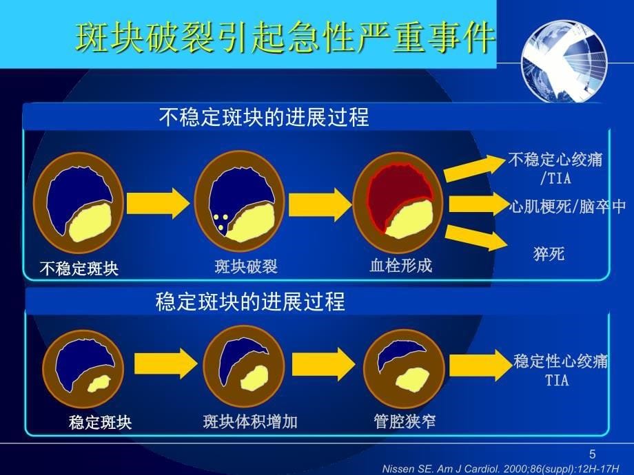 心肌梗死PPT幻灯片课件_第5页