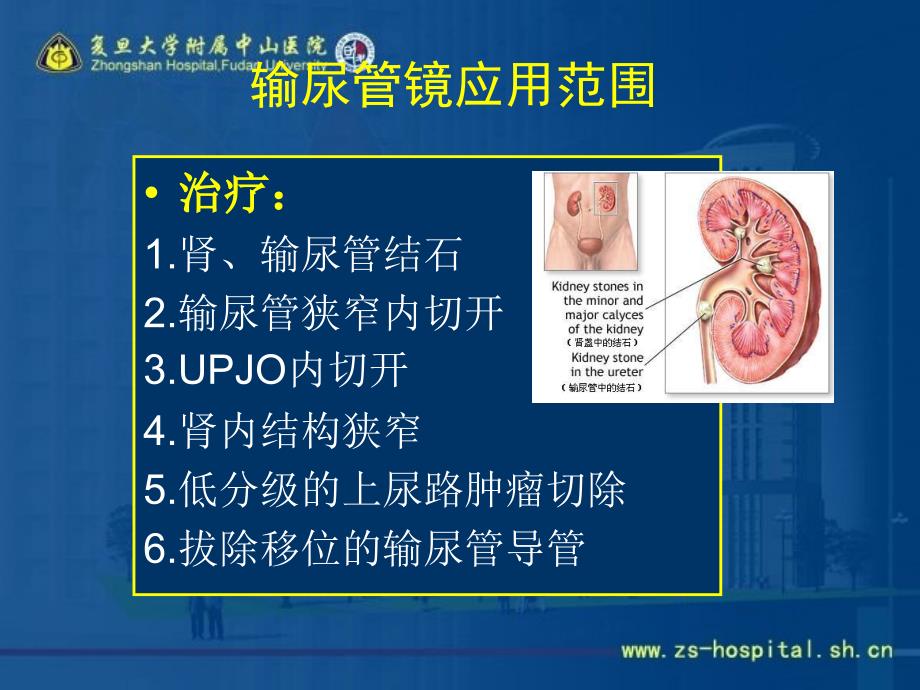 2015：输尿管镜手术并发症.ppt_第4页