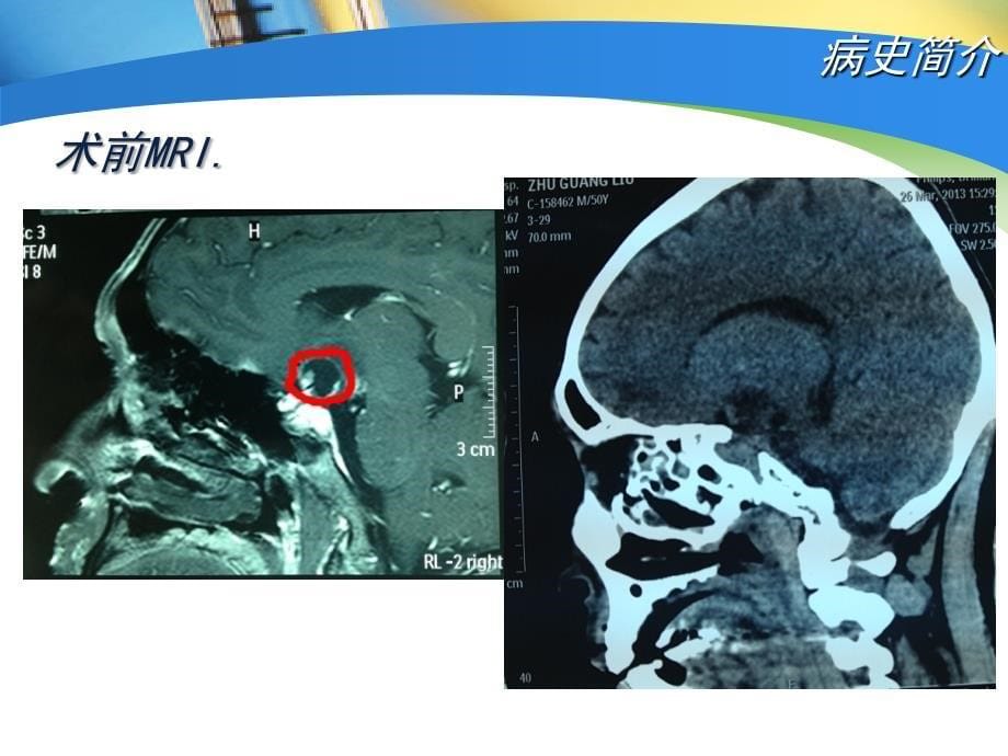 垂体瘤护理查房_第5页