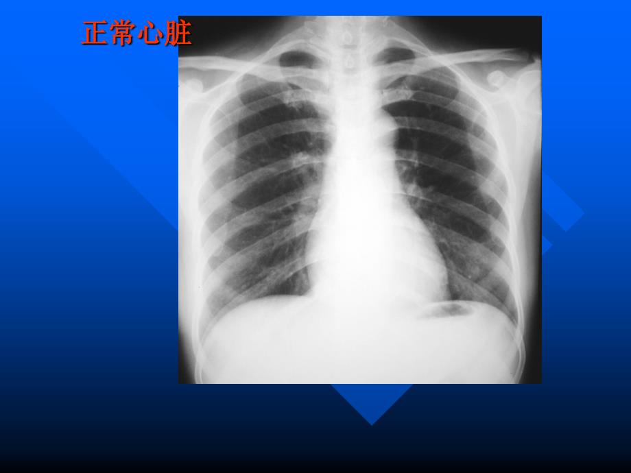 心脏常规都x线检查ppt课件_第2页