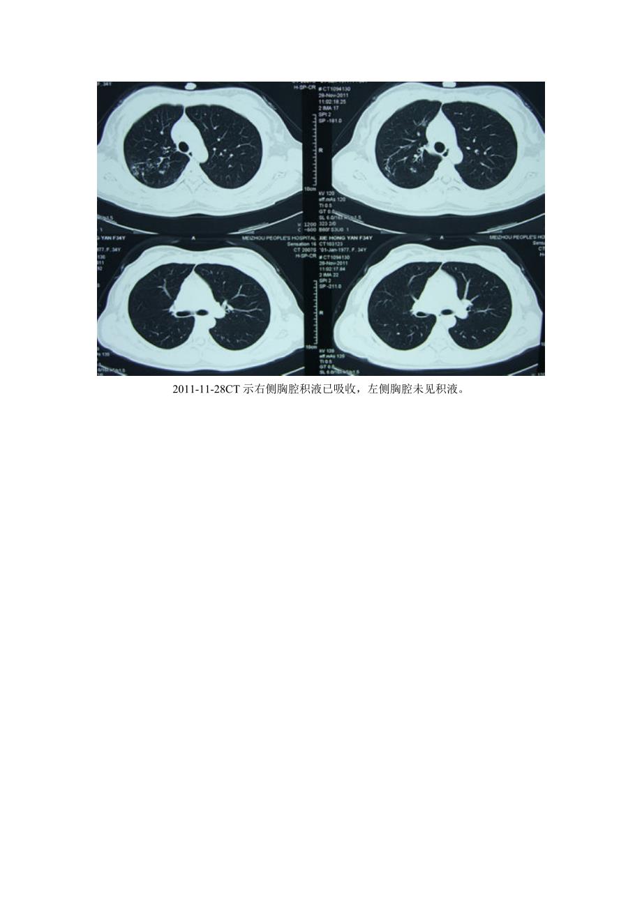 癌性胸腔积液临床案例剖析1_第4页