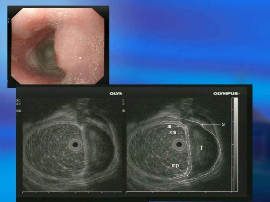 超声内镜的操作技巧_第5页