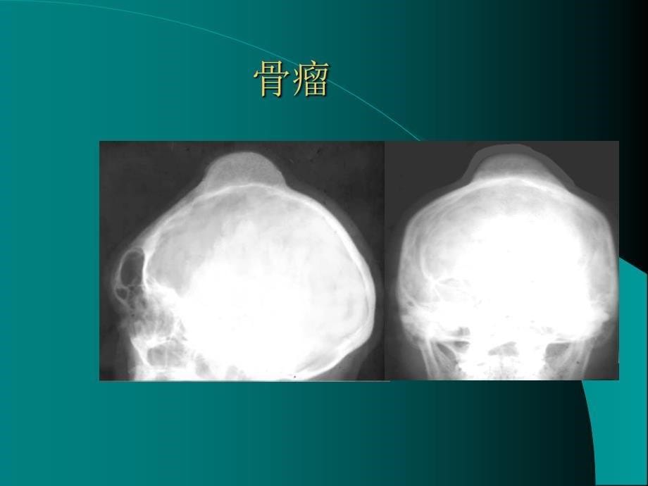 良性骨肿瘤诊断课件_第5页