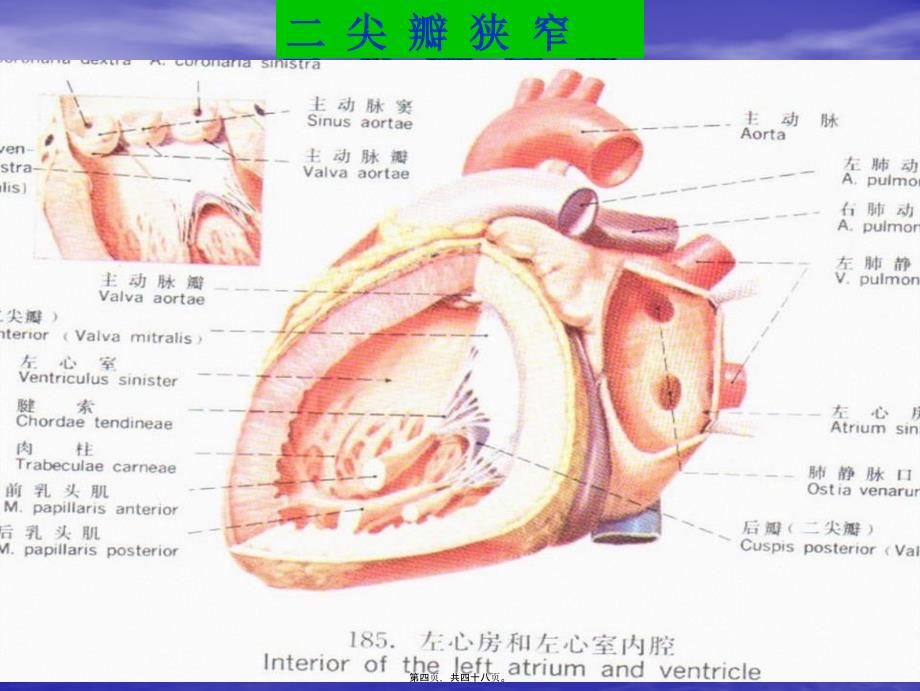 医学专题—二尖瓣狭窄的心脏体征8032_第4页