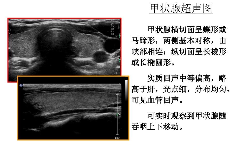 甲状腺的超声解读.ppt_第3页