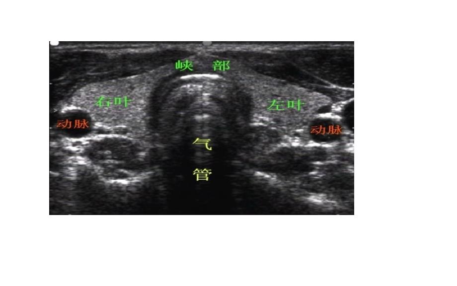 甲状腺的超声解读.ppt_第4页