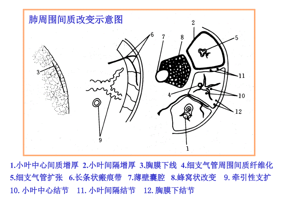 肺间质性病变改_第4页