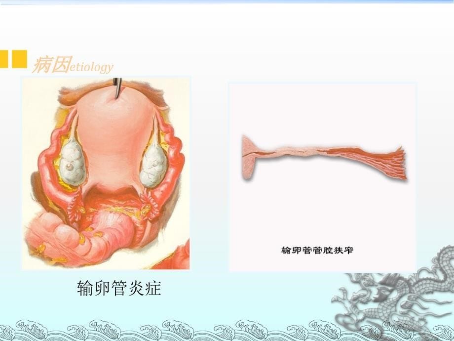 宫外孕的护理查房_第5页