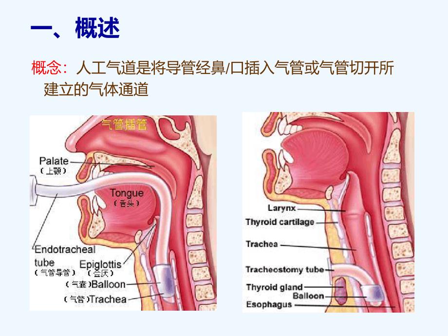 人工气道管理新进展.ppt_第3页