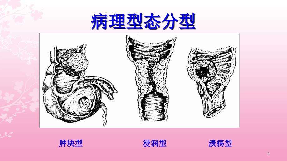 大肠癌病人的护理ppt课件_第4页