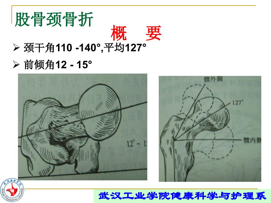 股骨颈骨折的康复_第2页