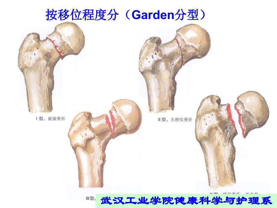 股骨颈骨折的康复_第4页