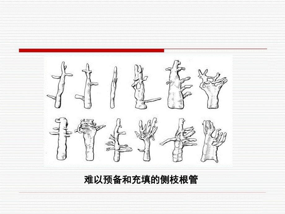 热牙胶充填术(技能培训).ppt_第5页