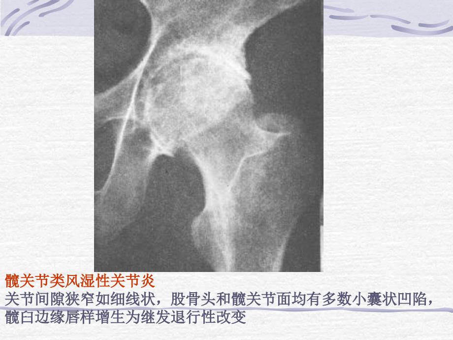 非化脓性关节炎课件文档资料_第4页