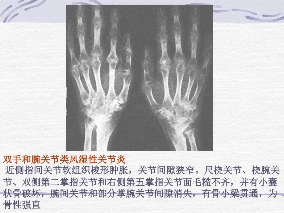 非化脓性关节炎课件文档资料_第5页