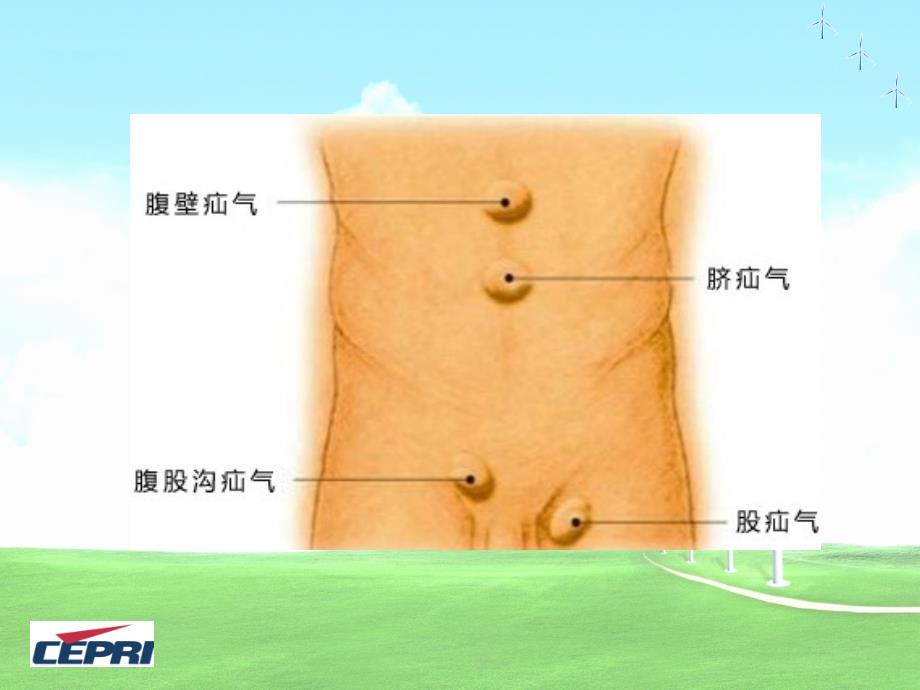 腹外疝科普-1_第5页