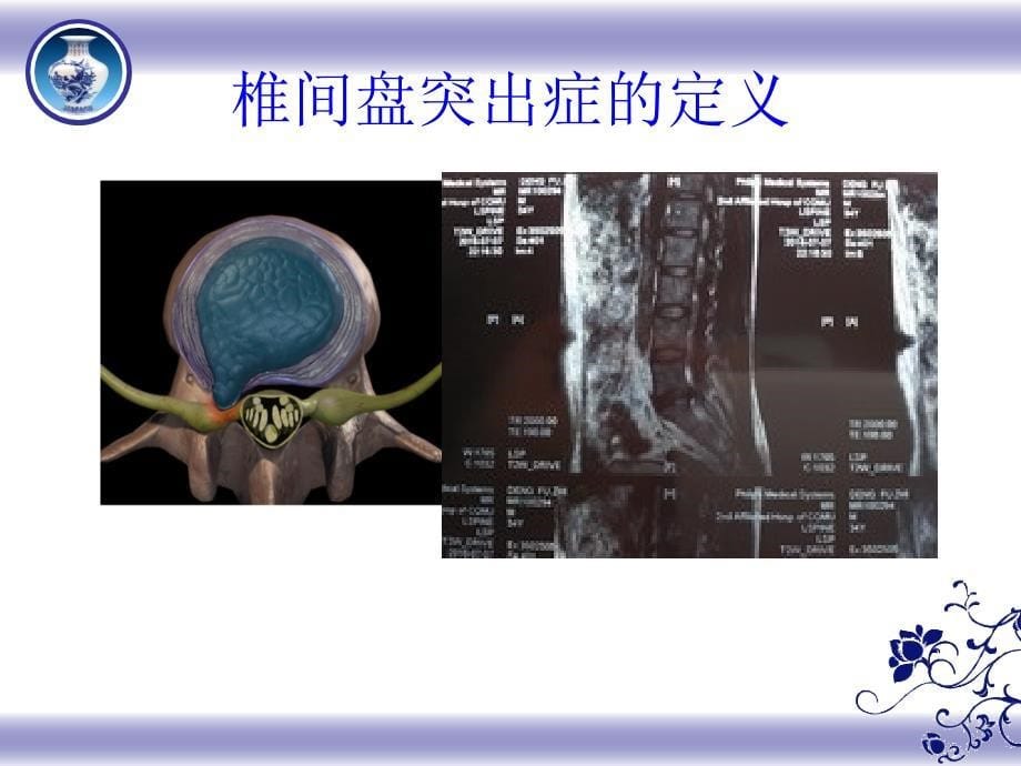 腰椎间盘突出症的护理程亚娟.PPT_第5页