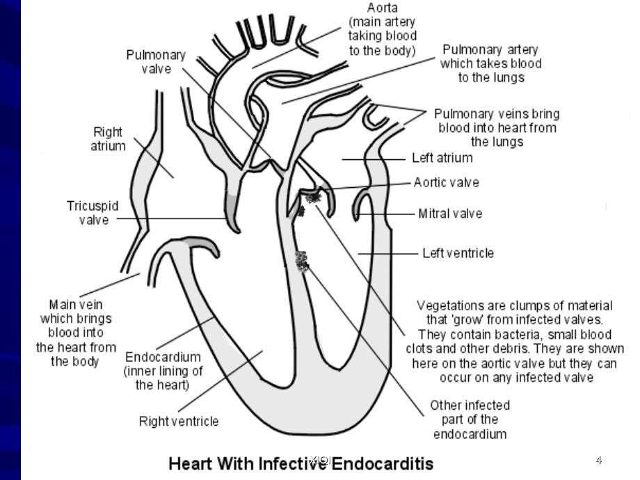 感染性心内膜炎--标准_第4页