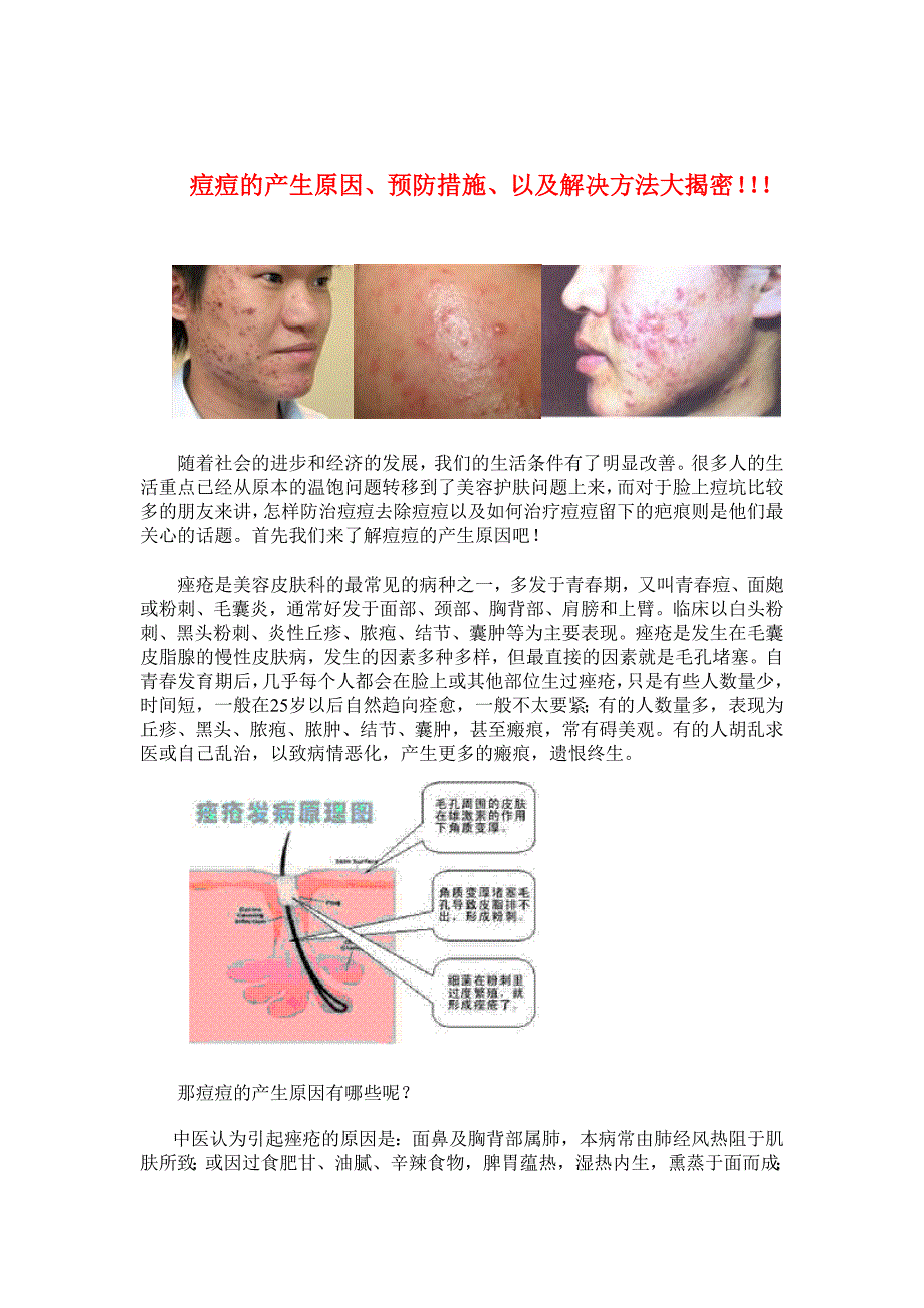 痘痘的产生原因、预防措施、以及解决方法大揭密_第1页