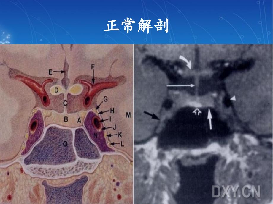 蝶鞍区域病变影像诊断与分析策略PPT通用课件_第4页