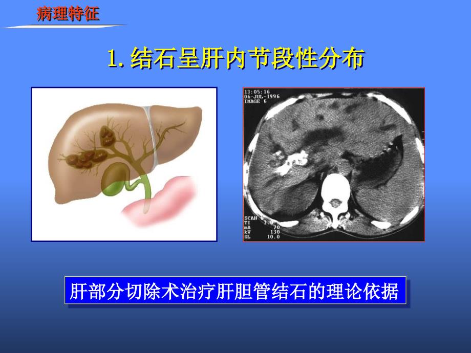 肝胆管结石病诊断治疗指南_第4页