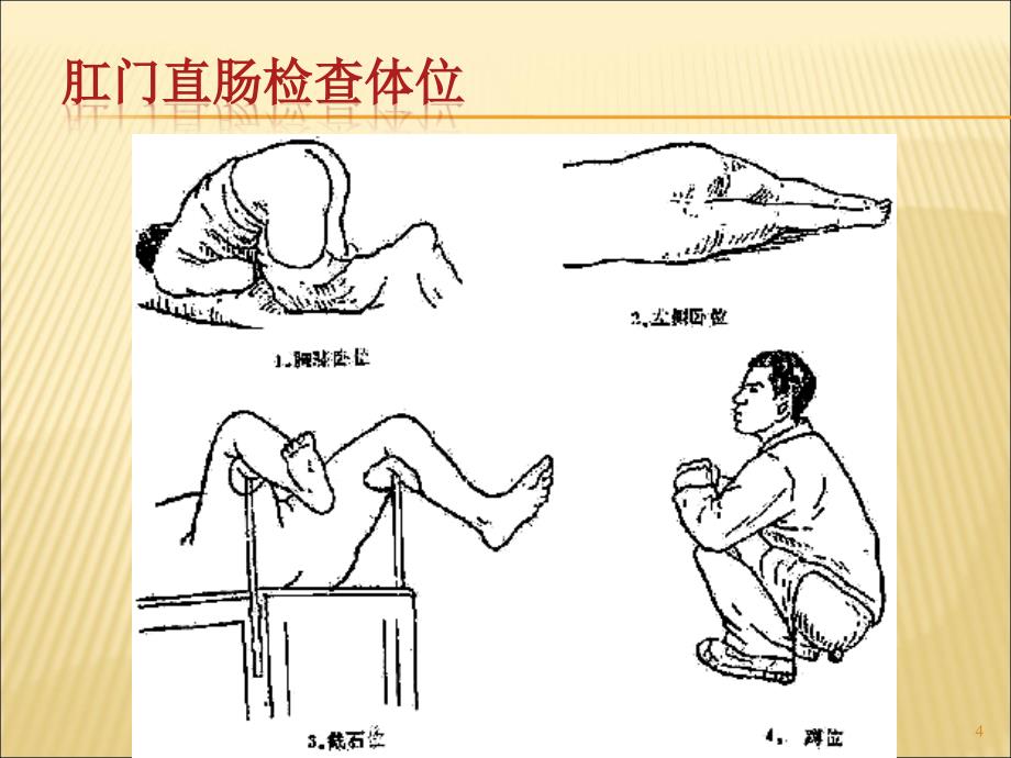 直肠肛管疾病病人的护理ppt课件_第4页