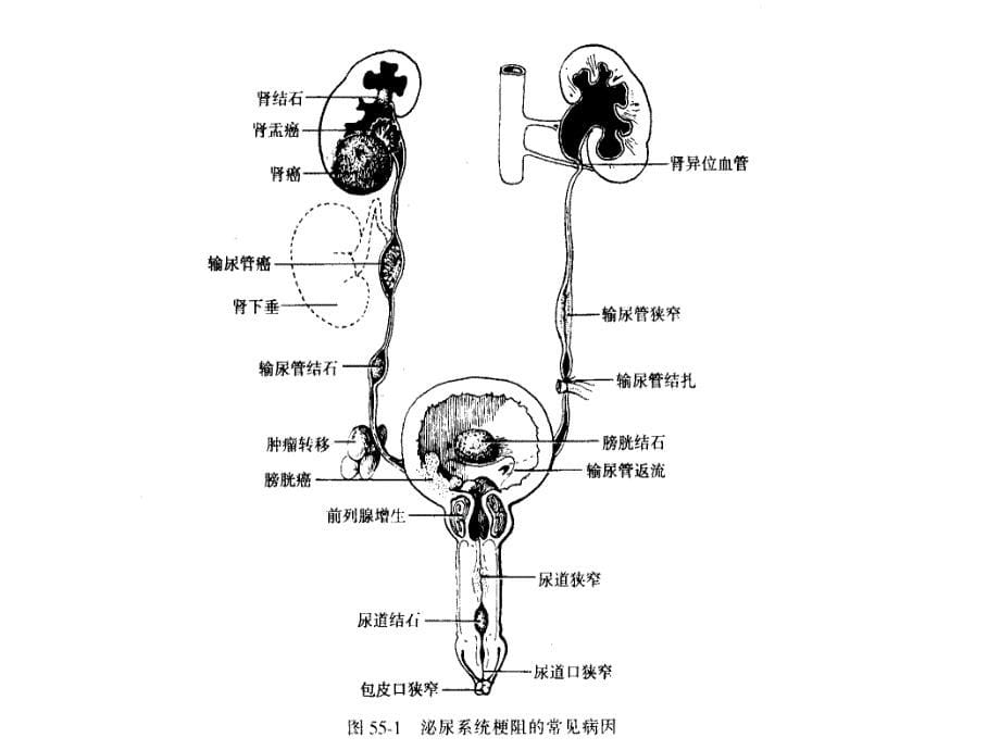 泌尿系统梗阻课件_第5页