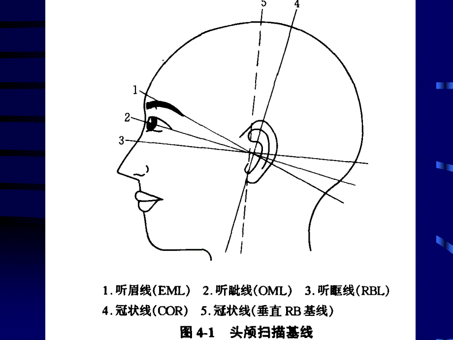 头颅CT断层解剖.ppt_第3页