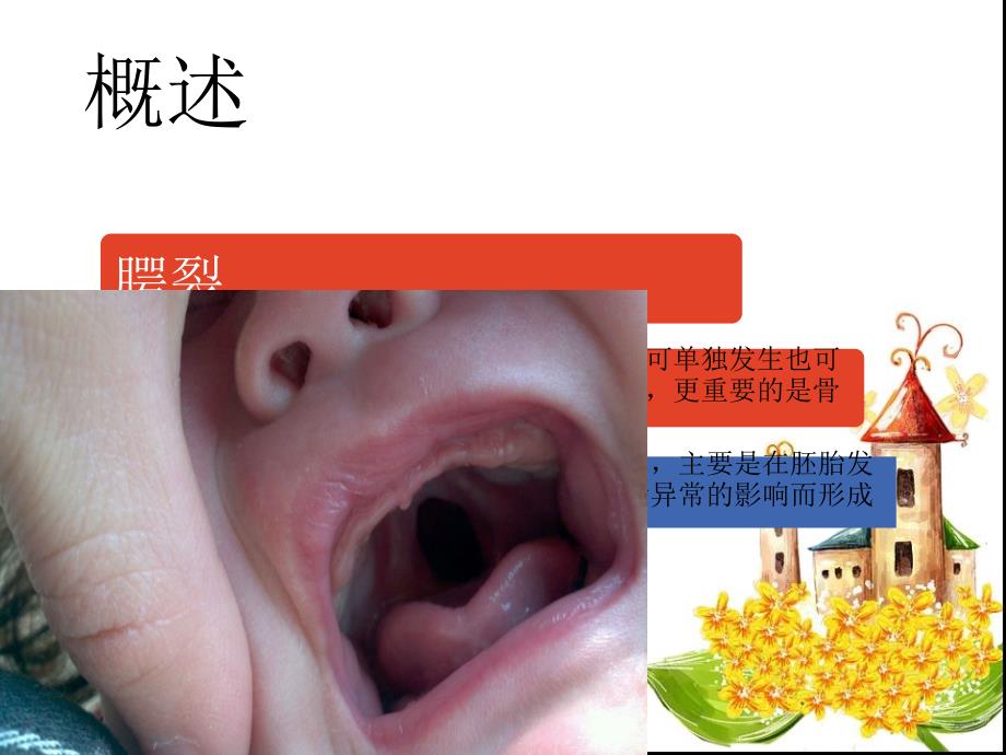 腭裂手术患儿的护理ppt课件.ppt_第3页