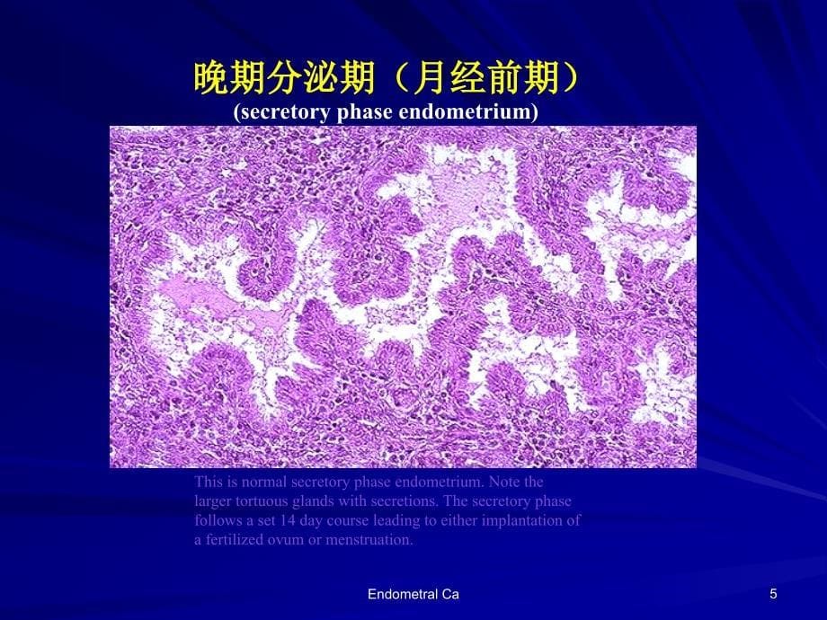 子宫内膜增生与子宫内膜癌前病变_第5页