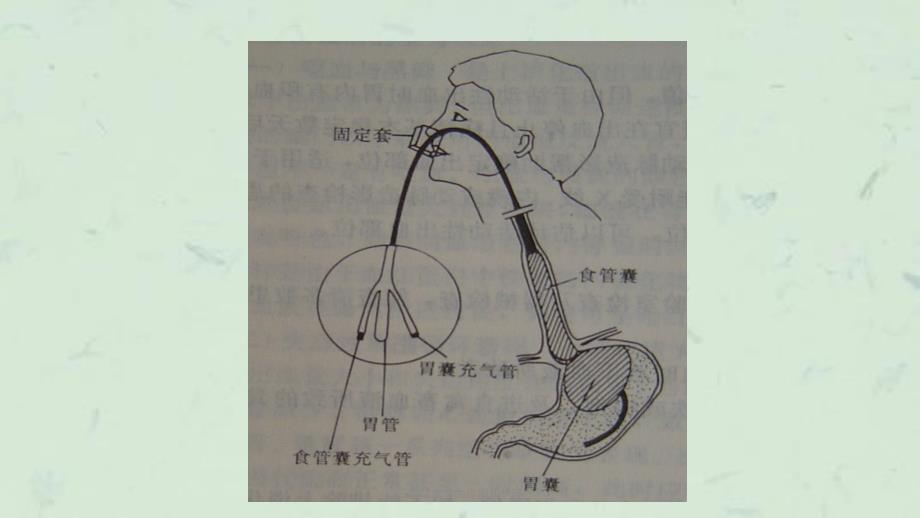 三腔二囊管的应用和护理课件_第3页